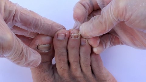 Hands with latex gloves pulling out toe nail of right foot. Painful scene closeup from point of view. Dry skin, fungus sickness, dermatologist, podiatry concepts