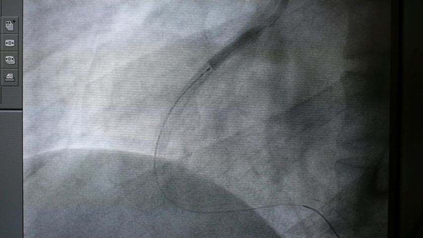 X ray image was performed balloon catheter inflation in percutaneous coronary intervention (PCI) procedure to right coronary artery (RCA)  Royalty-Free Stock Footage #1050925393