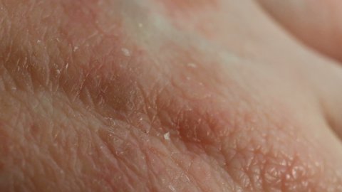 Atopic dermatitis caused by stress, allergies, fungal or bacterial infection. Red spots of the affected epithelium, severe itching, scabies. Comb your skin with your nails. Extreme close-up, real time