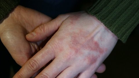Psychosomatic Allergy to touching people (men). Skin reaction to childhood abuse. There are finger marks on my hand