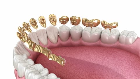 Lingual golden braces system. 3D animation concept of golden braces