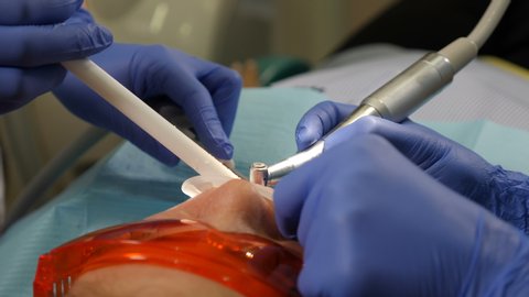 Dental treatment top view. Dentist at work, close-up. Patient Undergoes Medical surgical operation and Oral Cavity Treatment at modern dentistry. 4 k video