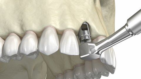 Bone grafting- augmentation using ring method, tooth implantation. Medically accurate 3D animation.