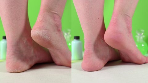 barefoot lady with dry skin problems on heels before and after pedicure procedure against green background of spa salon closeup