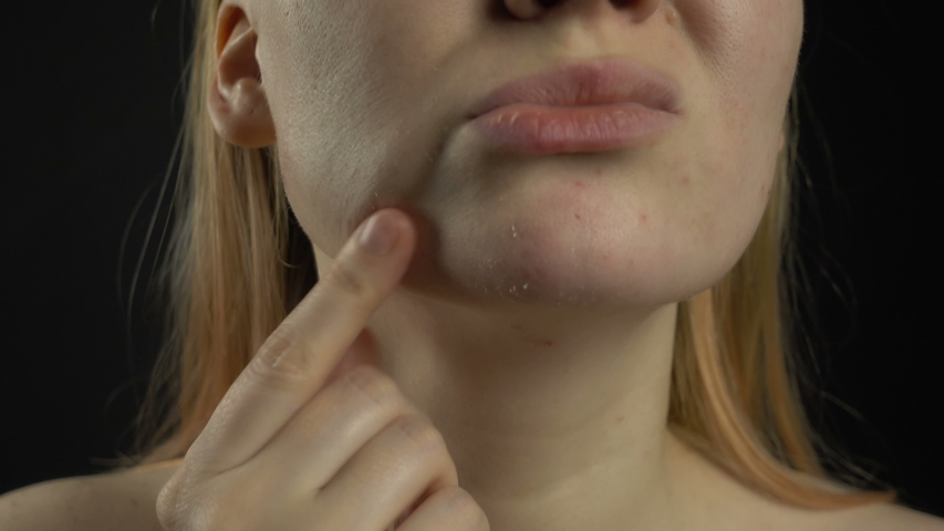 Close up of skin problems (unhealthy dry skin with acne and pimples). Unhappy caucasian female with irritation and dry chin. | Shutterstock HD Video #1051488676