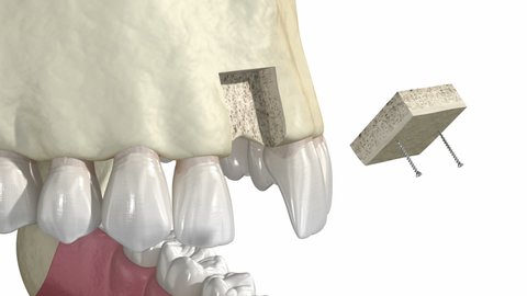 Bone grafting- augmentation using block of bone, tooth implantation. Medically accurate 3D animation.