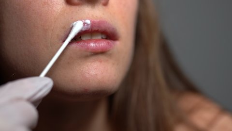 Woman in white latex protective gloves applying ointment on upper lip for viral herpes treatment. Viral inflammation on human lips, suffering from herpes sores on face