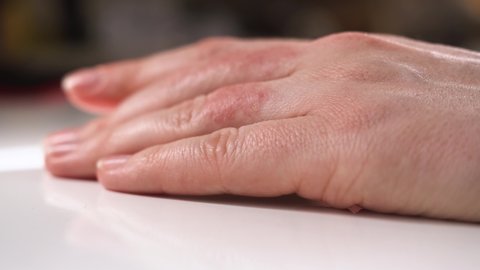 Girl or woman smears eczema on her hands with special healing ointment. Red swollen fingers require urgent treatment to improve patient health. Woman rubs two fingers. Close up macro.