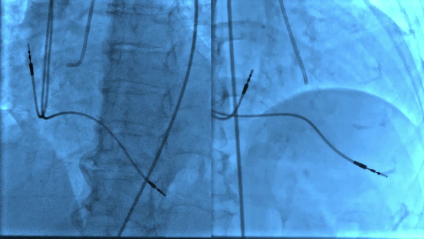 Right coronary angiography with dual chamber heart pacemaker multi views after percutaneous coronary intervention stemi patient in cardiac disease care at cardiac catheterization room. Royalty-Free Stock Footage #1051907863