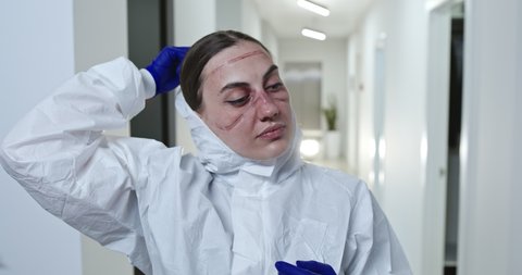 Tired female coronavirus health worker with face scars from protective uniform taking off hood after overwork with patients coronavirus infected in modern hospital. Respiratory virus, covid-19 concept