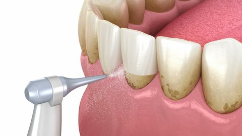 Oral hygiene: Air flow water Teeth Cleaning. Medically accurate 3D animation of human teeth treatment