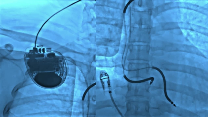 Fluoroscopy  AICD (Automatic Implantable Cardioverter Defibrillator) and leads after implantation again due to left side lead is fracture. Royalty-Free Stock Footage #1052135377