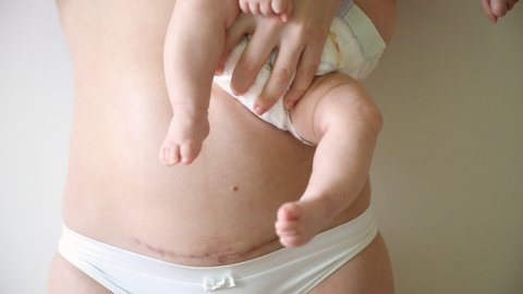 Closeup of woman belly with a scar from a cesarean section. Woman with baby on her hand, white bckground and nature light