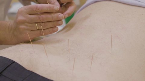 Therapist giving acupuncture treatment to a person