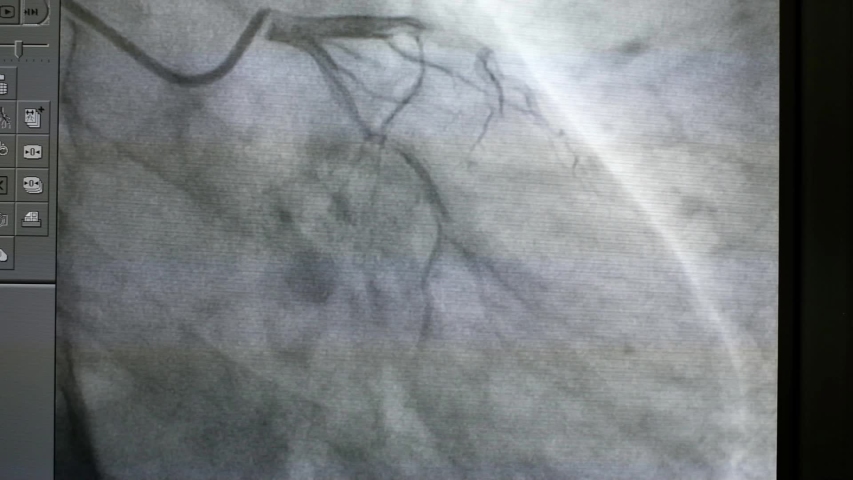 coronary angiogram show normal left coronary artery Royalty-Free Stock Footage #1052428837