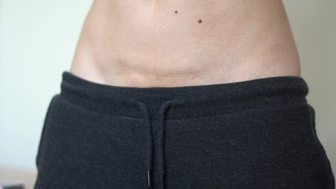 Woman with scar on her belly from c-section. Skinny fit abdomen. Postpartum recovery