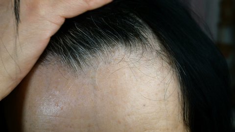 Mature adult woman removes hair from her forehead. Gray hair, alopecia and problematic skin on the head. Close-up. Indoors.