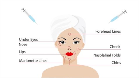 Cartoon animation of dermal Fillers  Treatment areas on facial skin of beautiful woman's face. Idea for beauty plastic surgery, cosmetology, professional anti aging business.