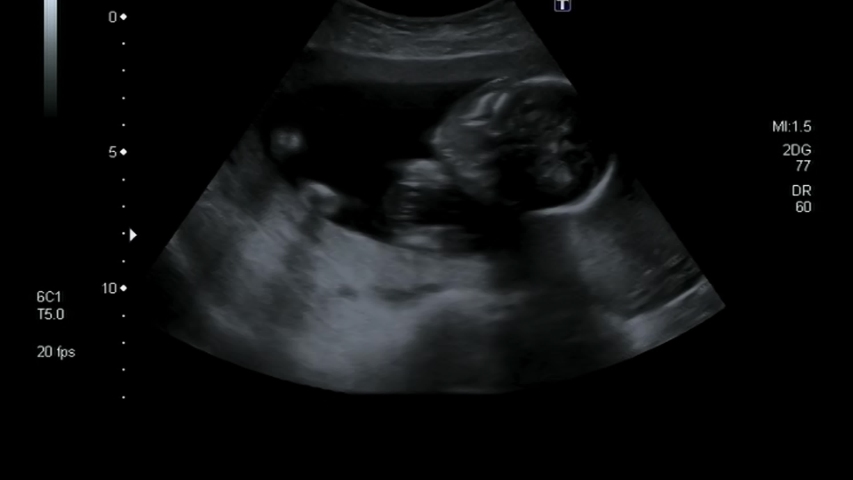Fast motion of an ultrasound examination of a pregnant woman with an embryo and luminous lines, echography of fetus Royalty-Free Stock Footage #1052616071