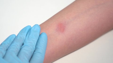 Closeup view 4k video of child hand with red spot reaction to conducting Mantoux test after 72 hours from injection.