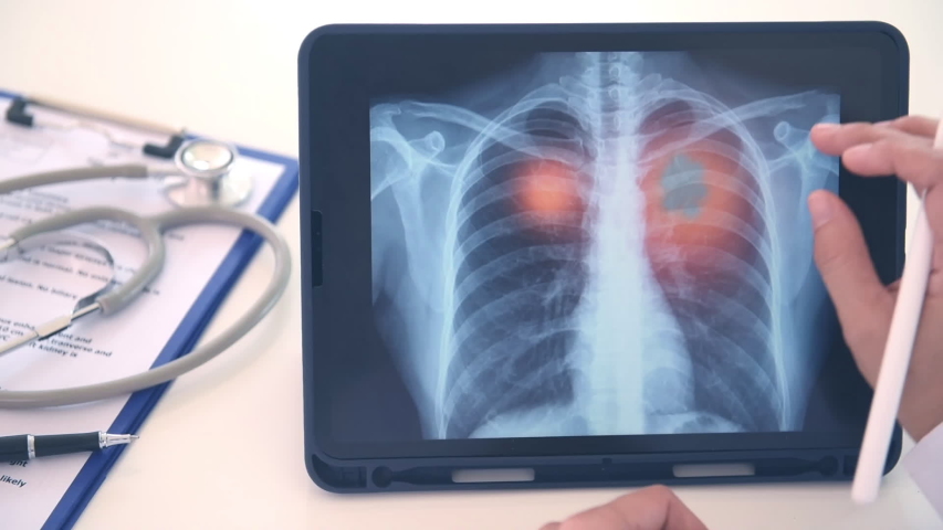pneumonia or lung inflamed. doctor check up patient chest x-ray image on digital tablet. Royalty-Free Stock Footage #1052796527