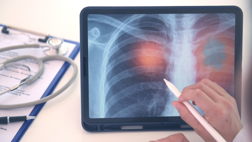 Pneumonia or lung inflamed. doctor check up patient chest x-ray image on digital tablet. | Shutterstock HD Video #1052796527