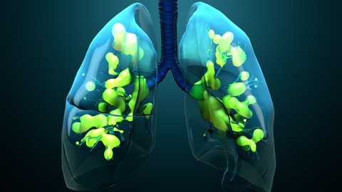 Damage lungs, severe respiratory illness, pneumonia, ARDS, acute respiratory distress syndrome caused by the coronavirus 4k