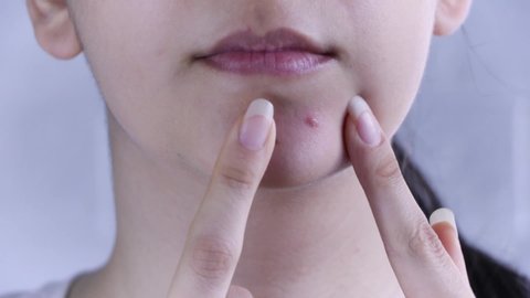 Skin care. A young woman squeezes out a pimple on her face. Skin treatment, beauty. Close up. Acne, redness, blemishes,spots, blackheads, cosmetology. Teen, hormones, oily skin. Panic, trouble