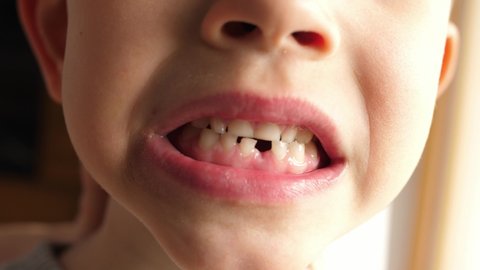 boy smiles and shows showing the hole after falling out of the milk tooth