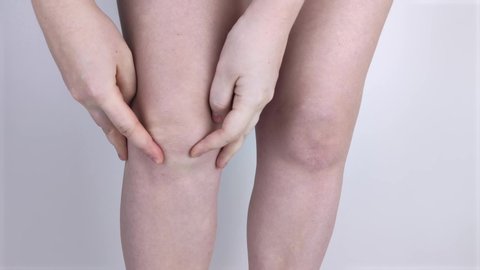 A woman suffers from knee pain. Examination by an orthopedist and traumatologist. Redness and swelling of the legs, torn meniscus or knee bursitis