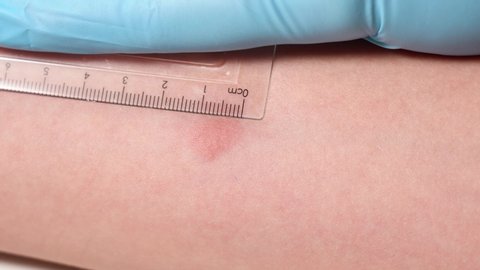 Closeup view 4k video of child hand with red spot reaction to conducting Mantoux test after 72 hours from injection. Nurse in blue gloves applying transparent ruler to check reaction.