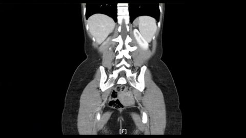 Abdominal CT Scan or abdomen mri. Computed tomography of the abdomen of human.
