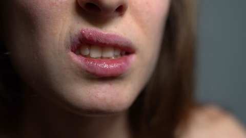 Body dehydratation and vitamins loss causing herpes sores on human lips