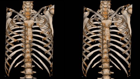 CT Scan Thoracic spine 3D and x-ray Thoracic spine finding The film shown thoracolumbar fracture injury after fall form height .Medical footage concept.