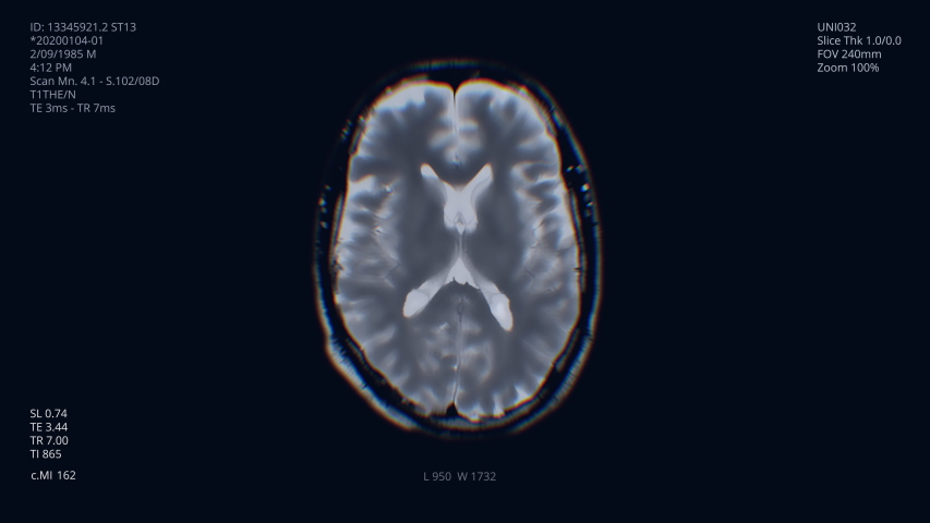 Brain scan visualization animation. Diagnosis data on laboratory display. Human illness research. Special medical equipment for tumor testing. Neurology test. X-ray. Tomography MRI, CT head examining | Shutterstock HD Video #1053405383