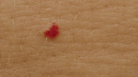 red moles on the patient s skin, hemangioma, angioneuromas, copy space, medical. Birthmark