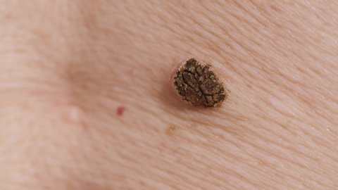Cancer mole on the body