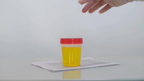 Urinalysis, Drug Testing, Drug, pills. Plastic jars for medical tests. Urine test