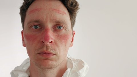 Male Nurse with Face Bruised and  Rubbed Raw by Face Mask. Closeup Portrait