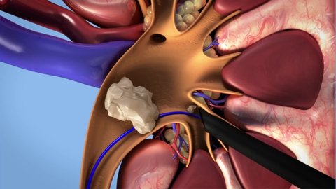 animation of crushing stones in the kidney