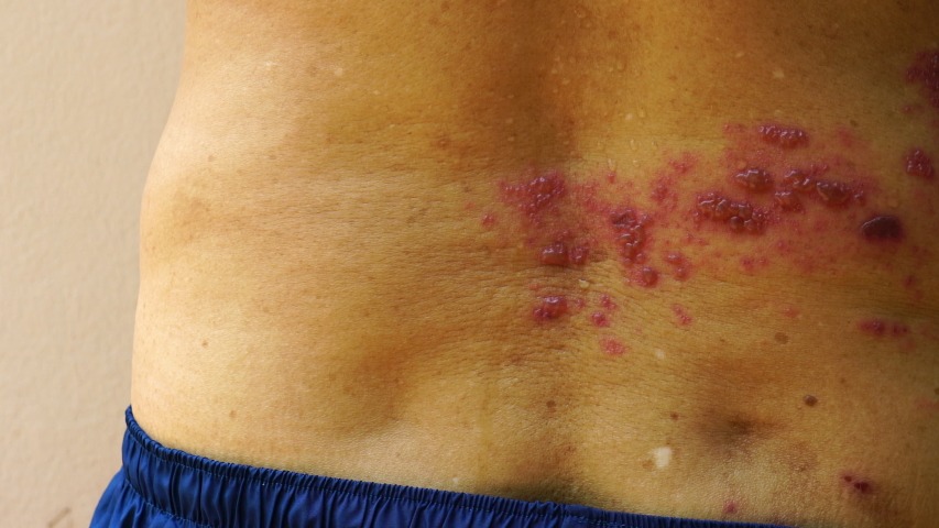 Skin lesion symptom in Shingles or Herpes zoster in human. Shingles or Herpes zoster is aviral disease caused by varicella zoster virus charatrized by a painful skin rash with blisters on the body. Royalty-Free Stock Footage #1054132664