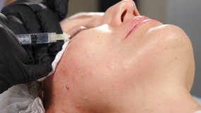 Mesotherapy, skin lifting and rejuvenation. Beauty clinic concept. Cosmetologist making mesotherapy injection. Microneedle mesotherapy. Close -up. Female face zone treatment at clinic. 4 k video