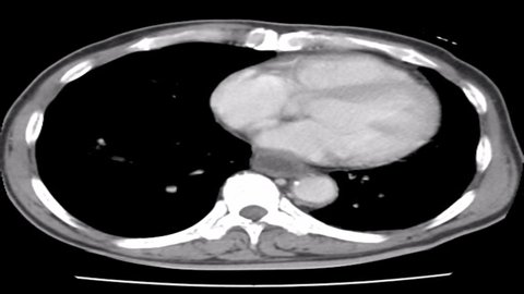 CT scan Axial view for diagnosis Abdominal aortic aneurysm
An abdominal aortic aneurysm is a localized enlargement of the abdominal aorta such that the diameter is greater than 3 cm 