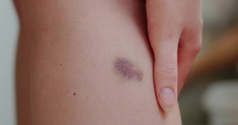 bruise on the girl's leg close up