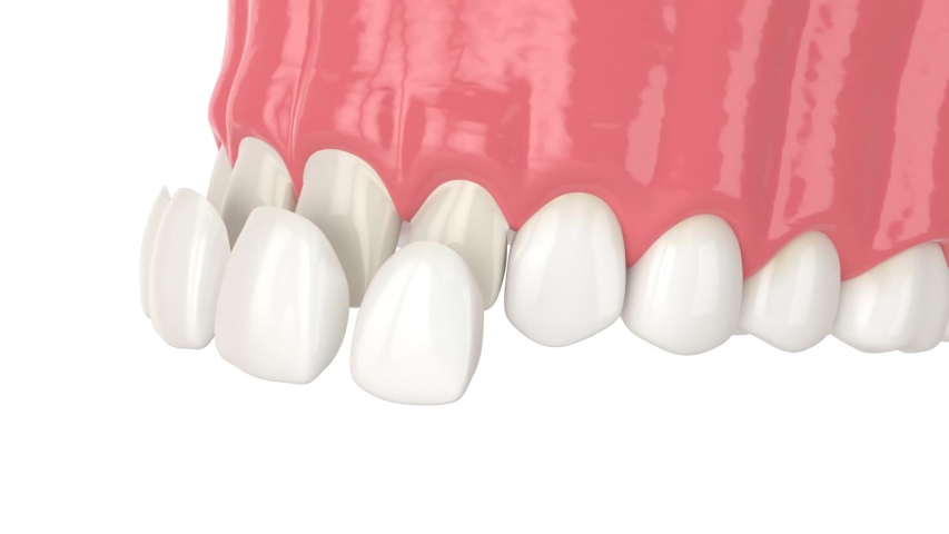 Upper jaw with installing dental veneers | Shutterstock HD Video #1054345862