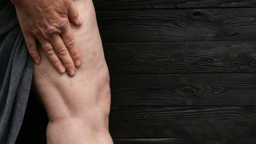 Bad leg and Illness of human skin. Swollen veins, cellulite and age spots, possibly its varicose veins on his leg. Close up. Royalty-Free Stock Footage #1054347140