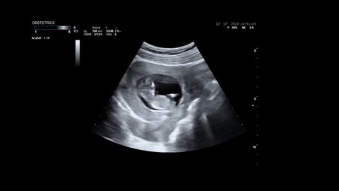 Ultrasonography of pregnant woman. Ultrasound of baby body and spine. Tiny baby is turning in mother's belly. 12 weeks of life. Baby in mother's womb is moving during sonography.
