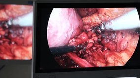 Doctors use endo-instruments and video cameras to perform surgery in the abdominal cavity of a fat man. New technologies in medicine. Laparoscopic surgery on the monitor