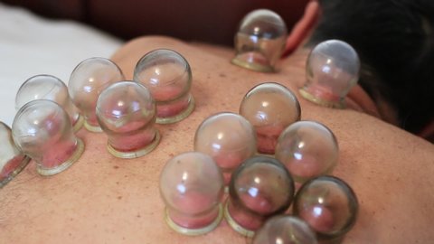 Man With Acupuncture Cupping Treatment