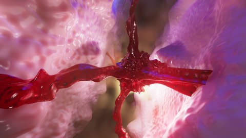 3D Animation of a growing Cancer Tumor or Metastasis spreading on healthy Tissue.